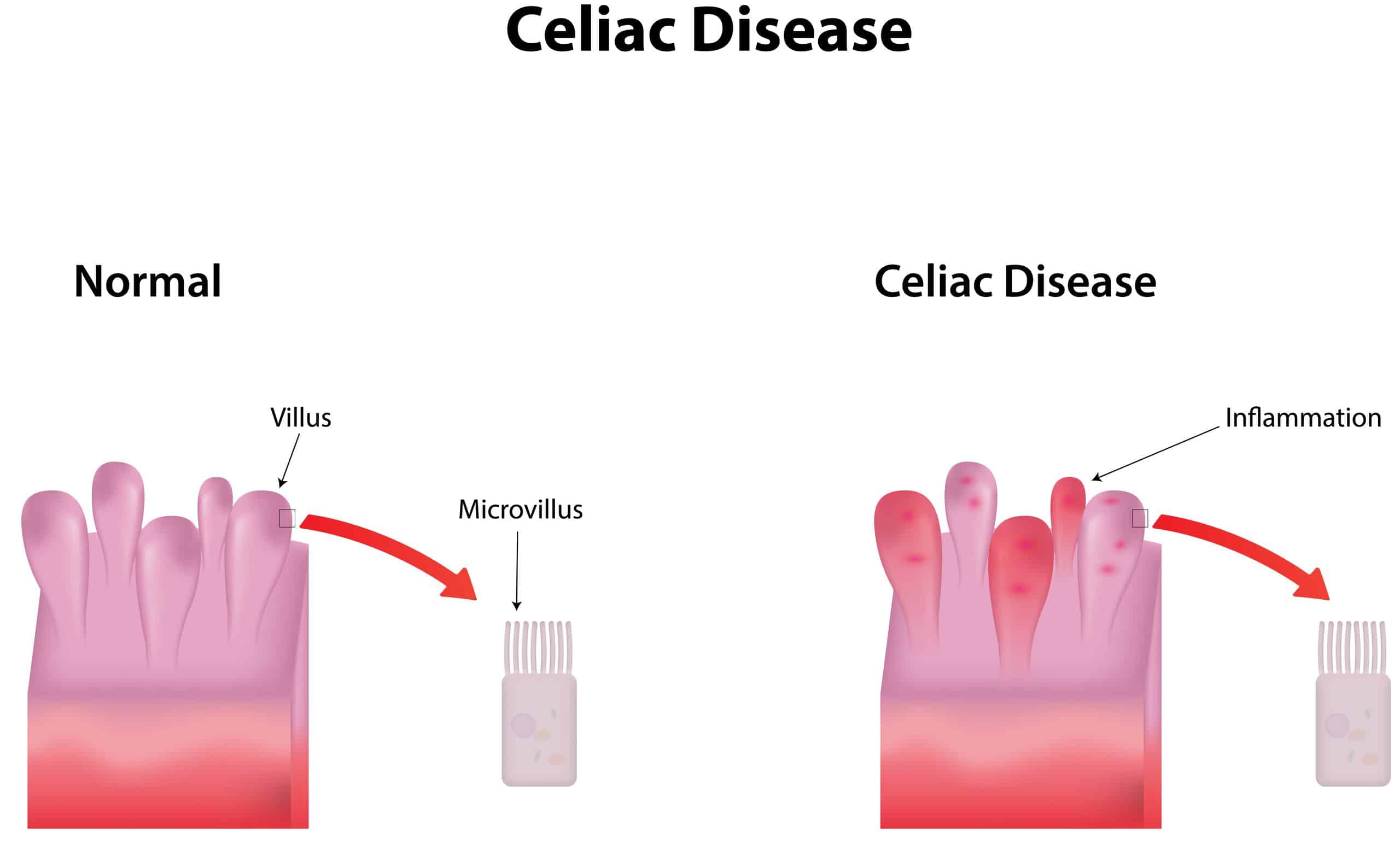Celiac disease