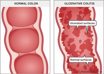 An illustration of a normal colon vs ulcerative colitis