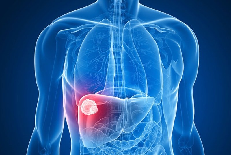 An illustration of a liver tumor