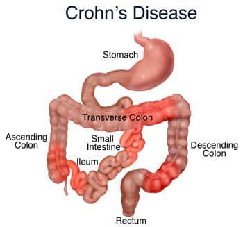 Crohn’s Disease symptoms