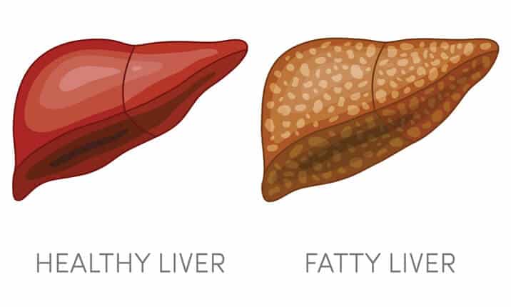 An illustration of a healthy liver and fatty liver