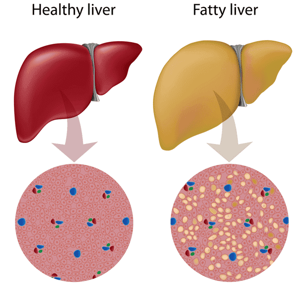 Difference between healthy liver and fatty liver experiencing NASH