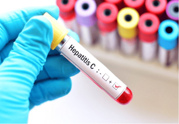 Hepatitis C infection
