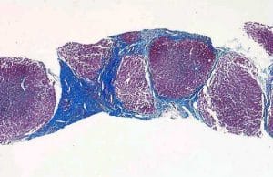 Liver Cirrhosis detected via a scan