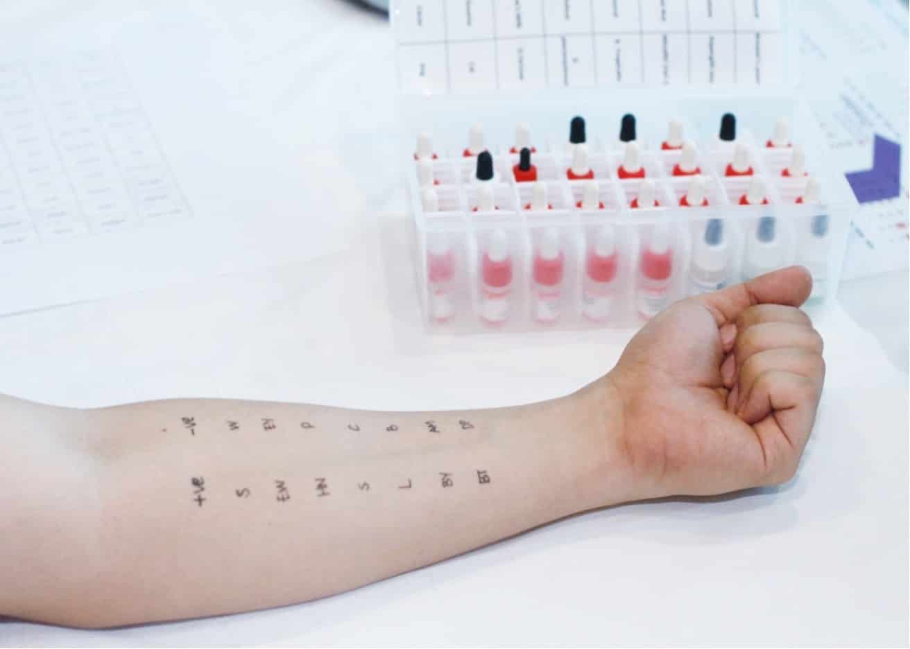 Picture of patient's arm resting beside bottles of allergen waiting for skin prick test