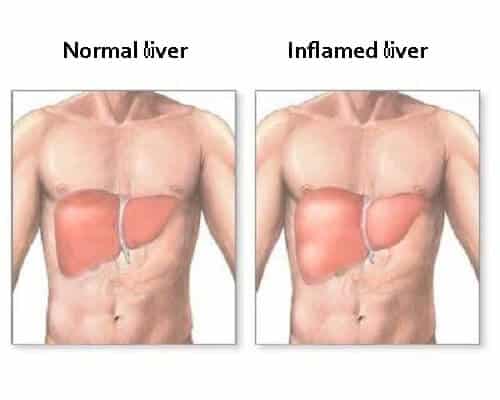 An illustration of a normal liver and an inflamed liver