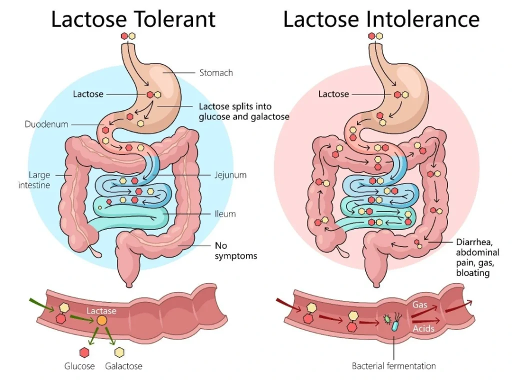 symptoms of lactose intolerance in adults in Singapore.