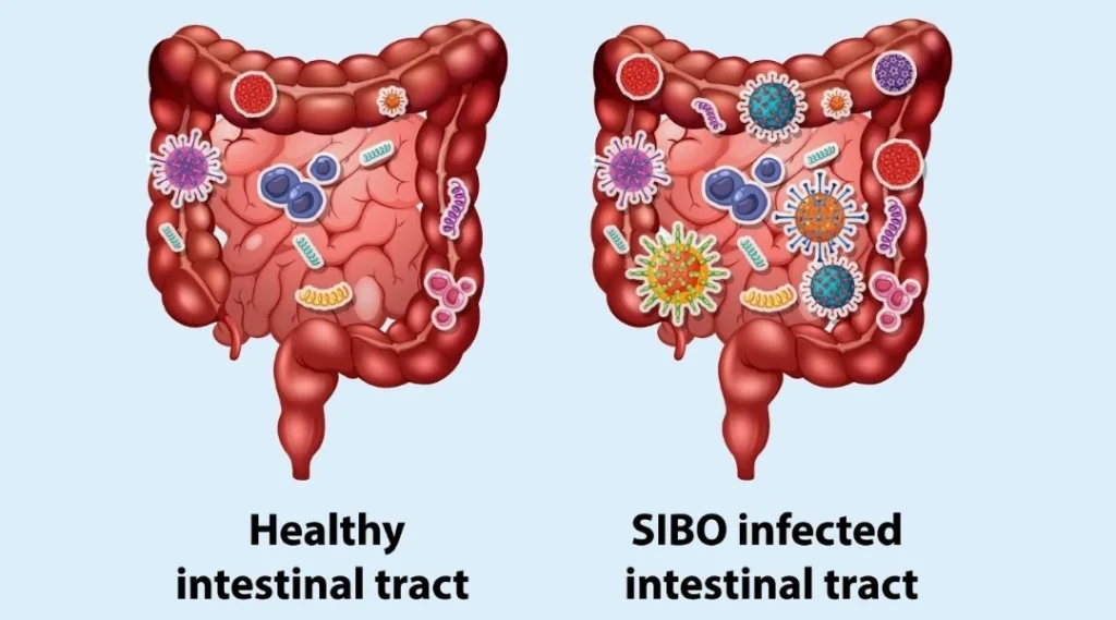 small intestinal bacterial overgrowth SIBO Singapore.