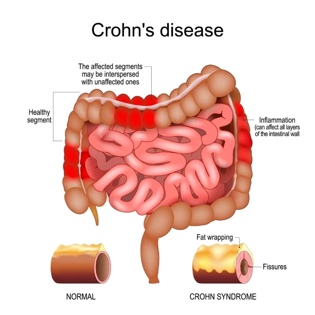 SIBO bloating abdominal pain gas fermentation.