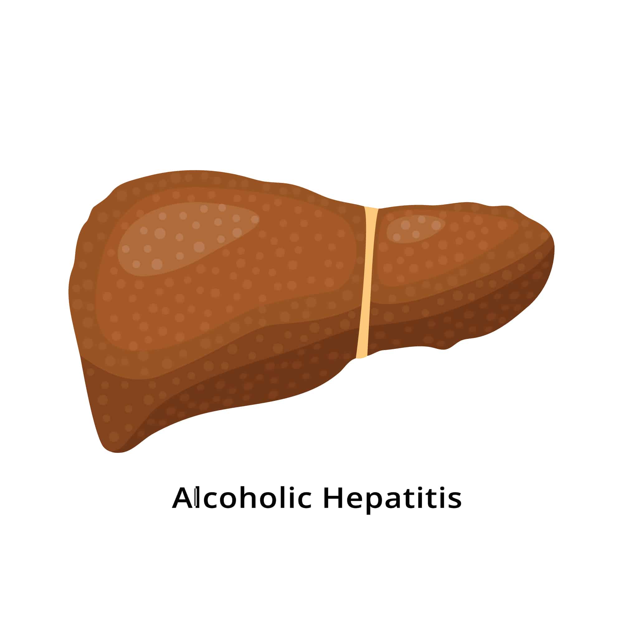 Alcoholic hepatitis