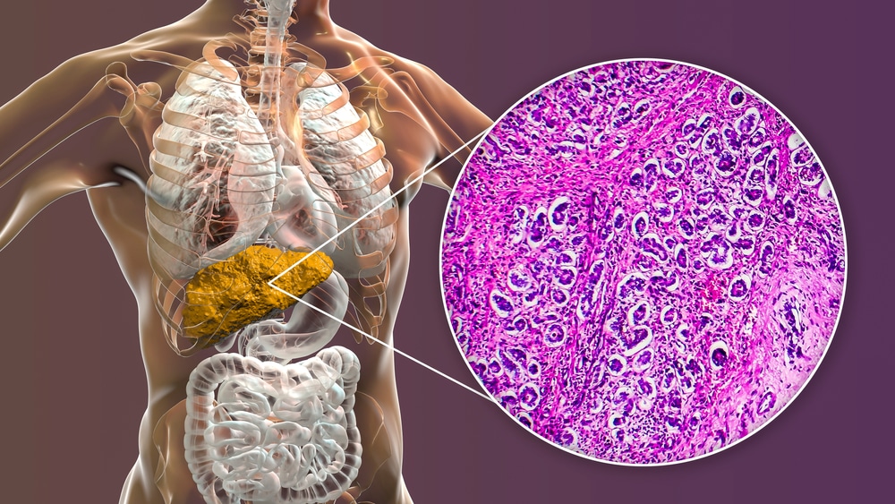 Liver Cirrhosis detected via a scan