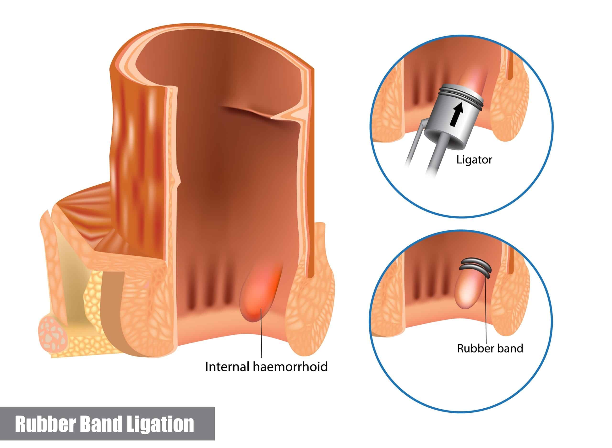 rubber band ligation