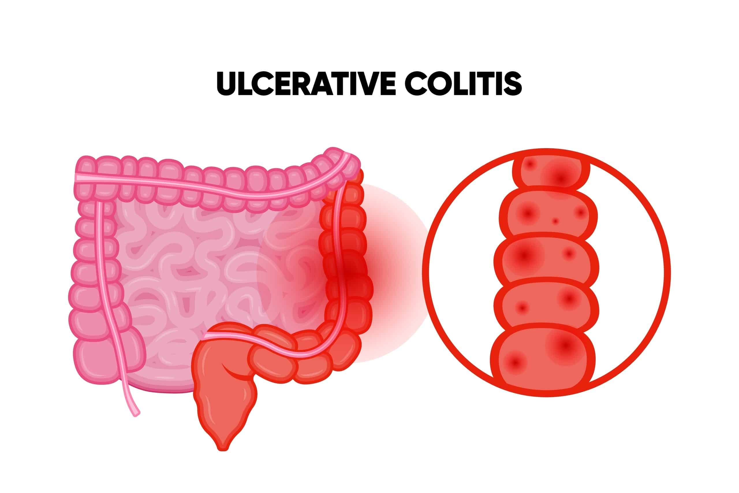 A picture of ulcerative colitis-inflammation (UC)