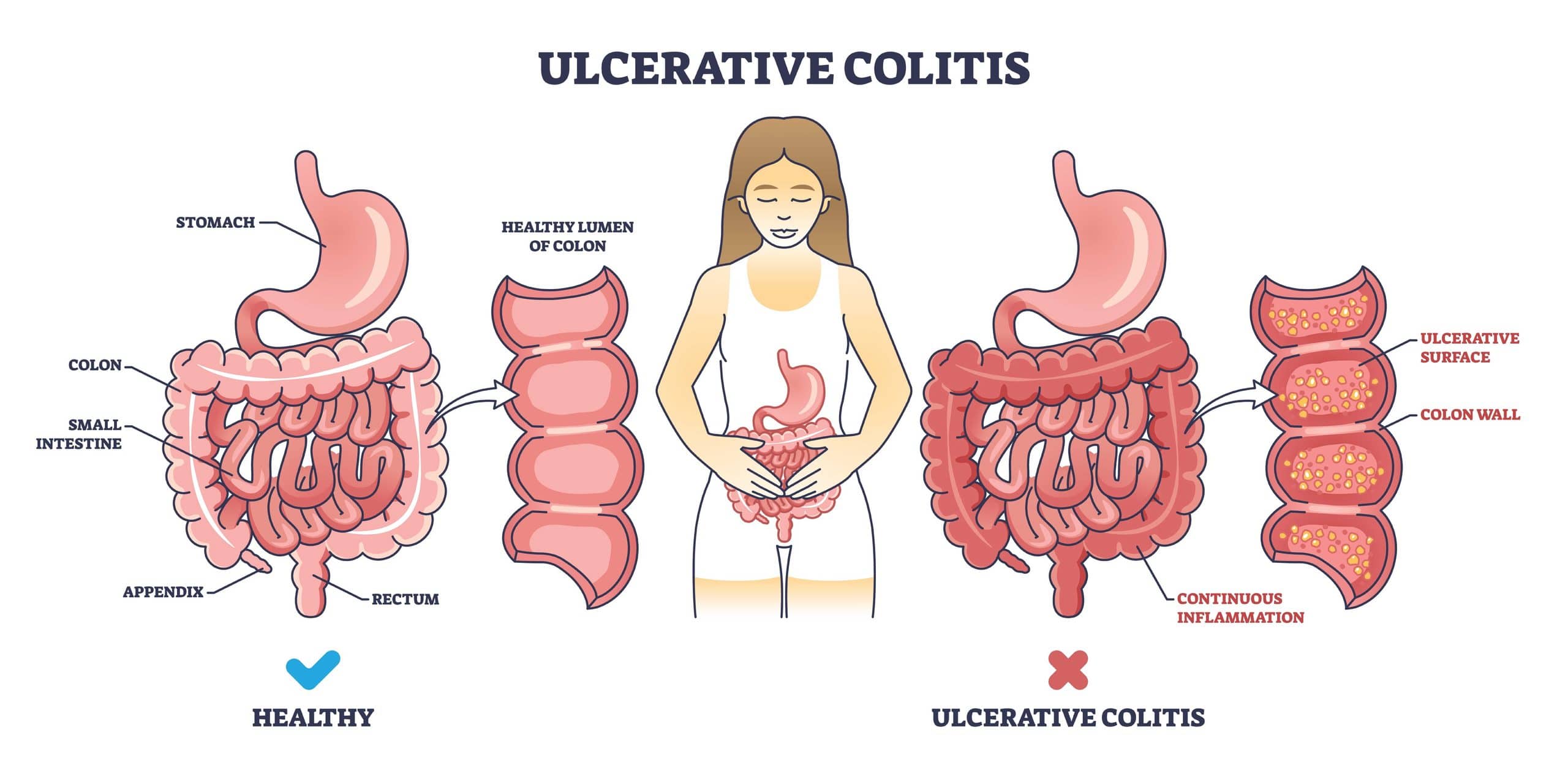 normal colon vs ulcerative colitis