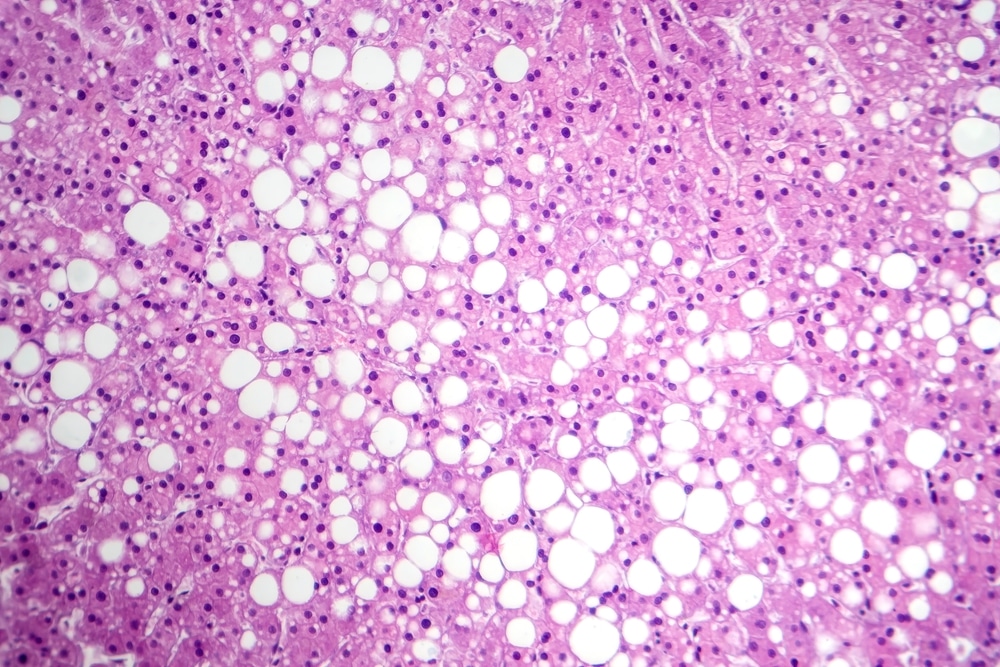 fatty liver cells