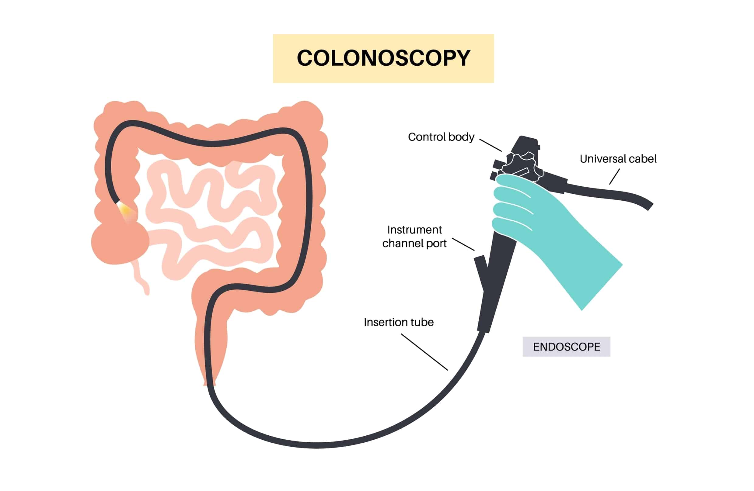 colonoscopy for ulcerative colitis