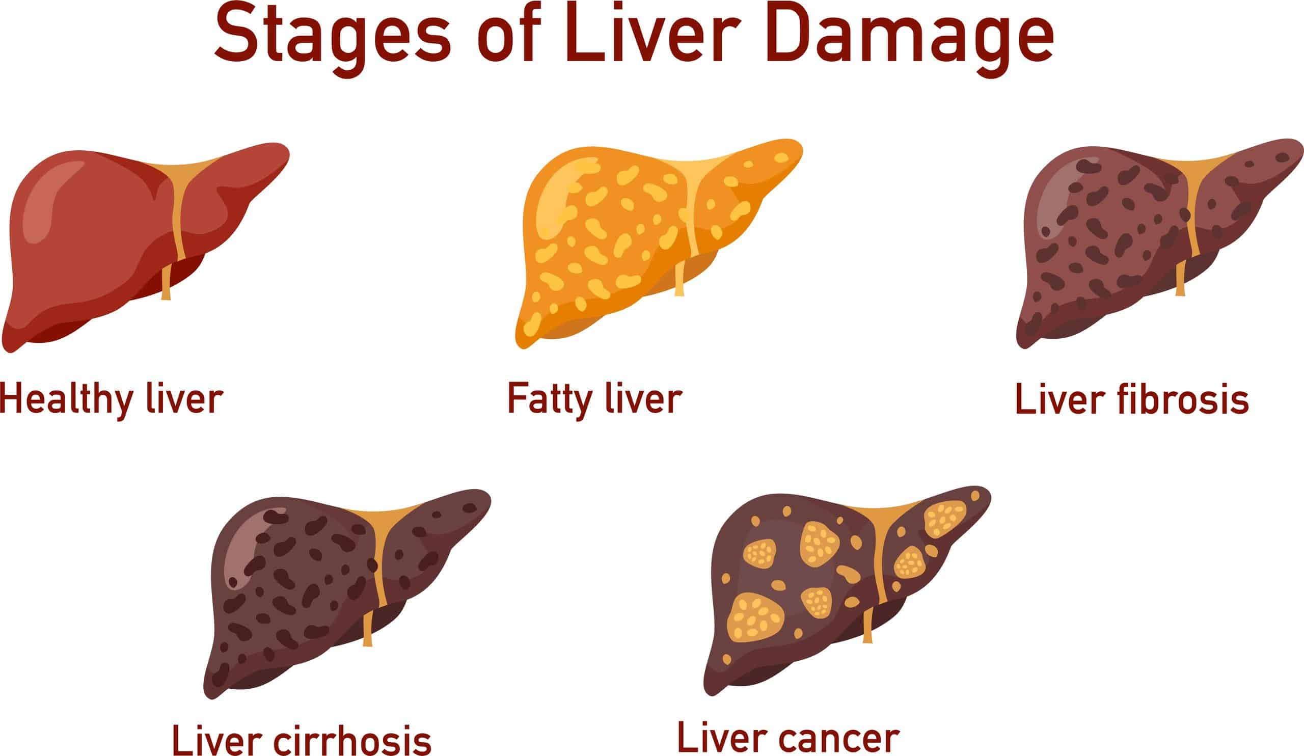 risk of liver cancer in liver cirrhosis
