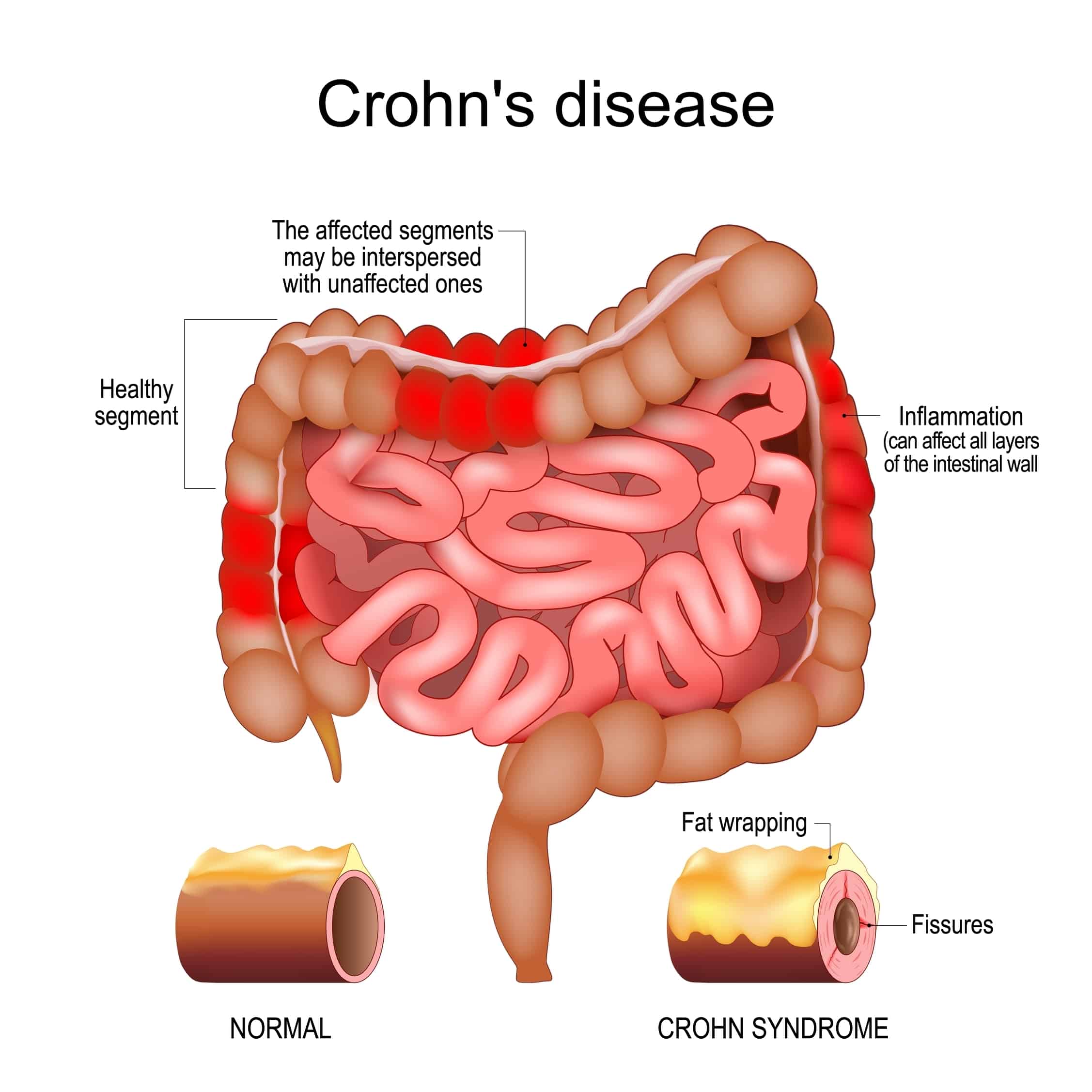 crohn’s disease