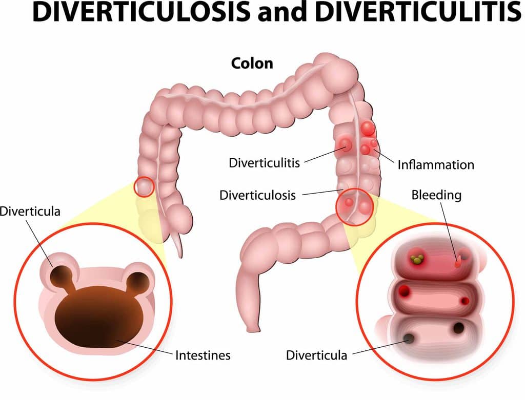 diverticulosis vs diverticulitis