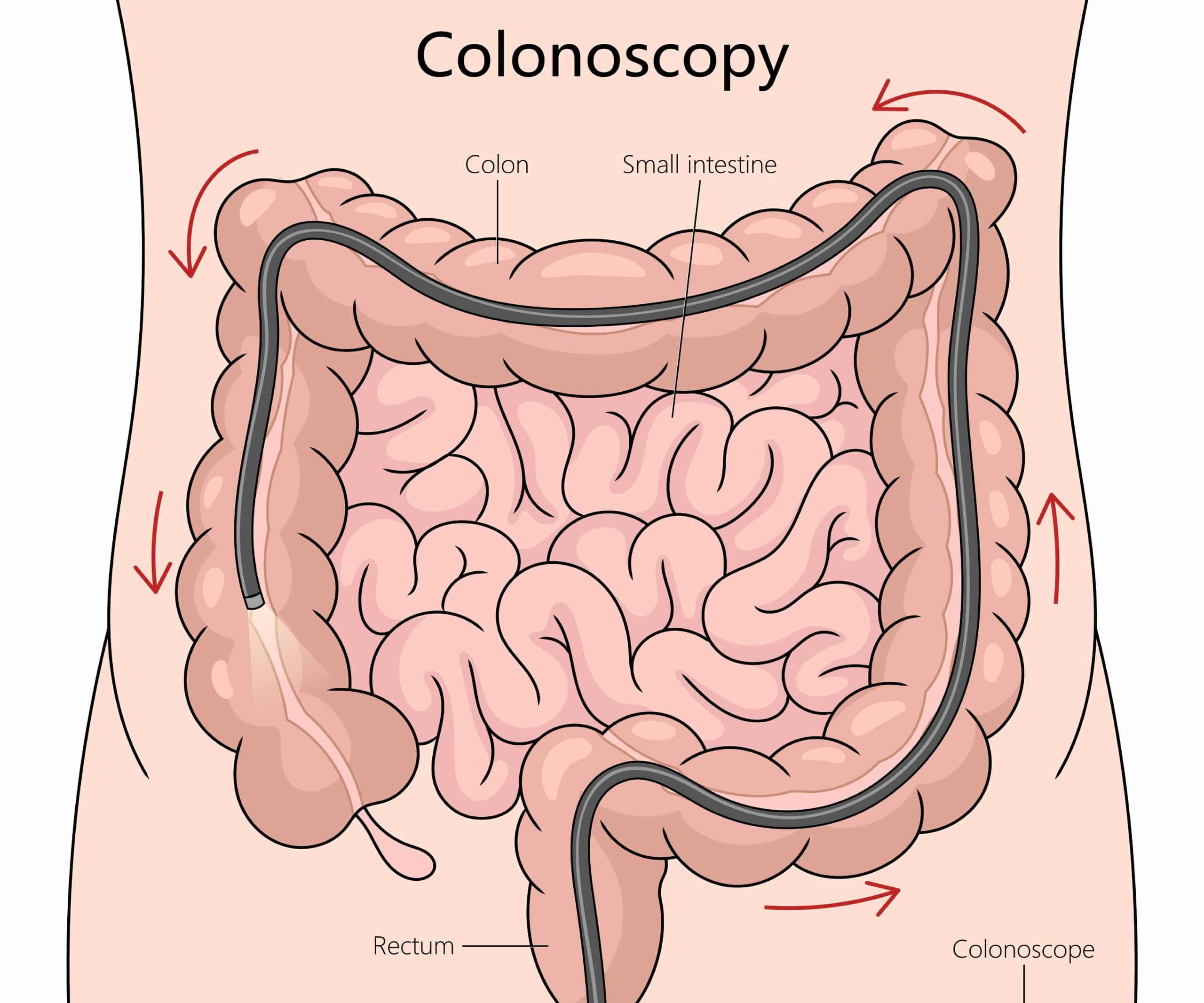 Colonoscopy Screening
