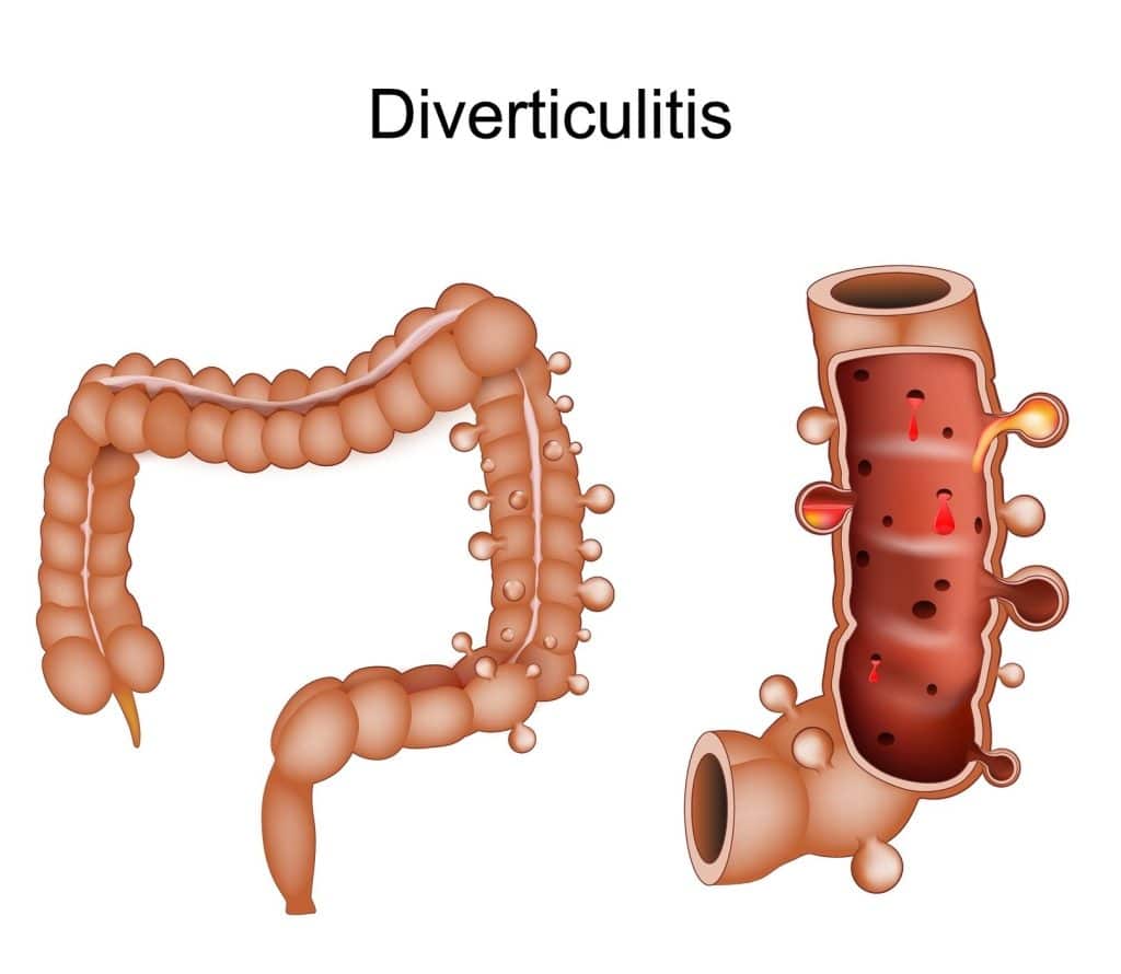 diverticulitis