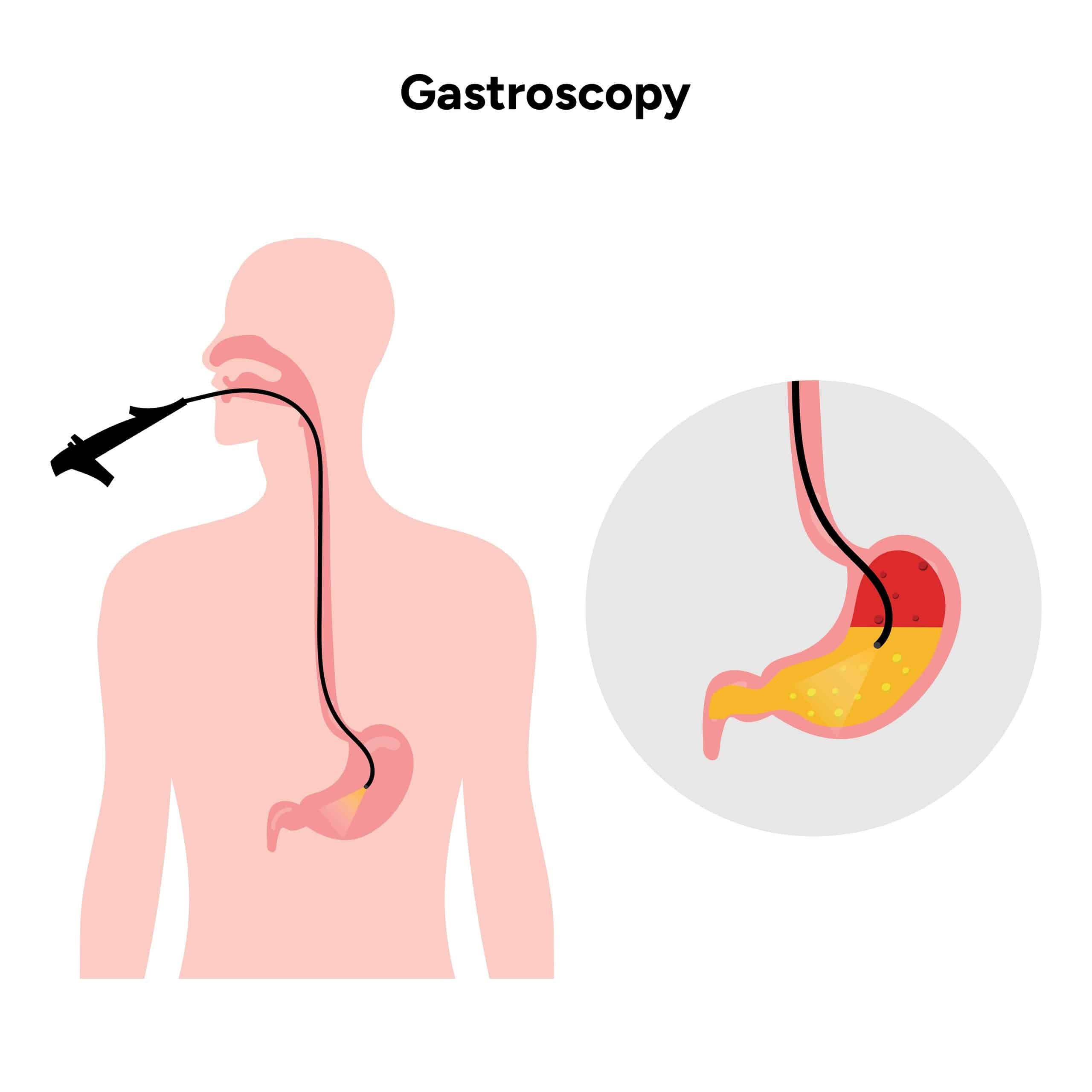 gastroscopy Singapore