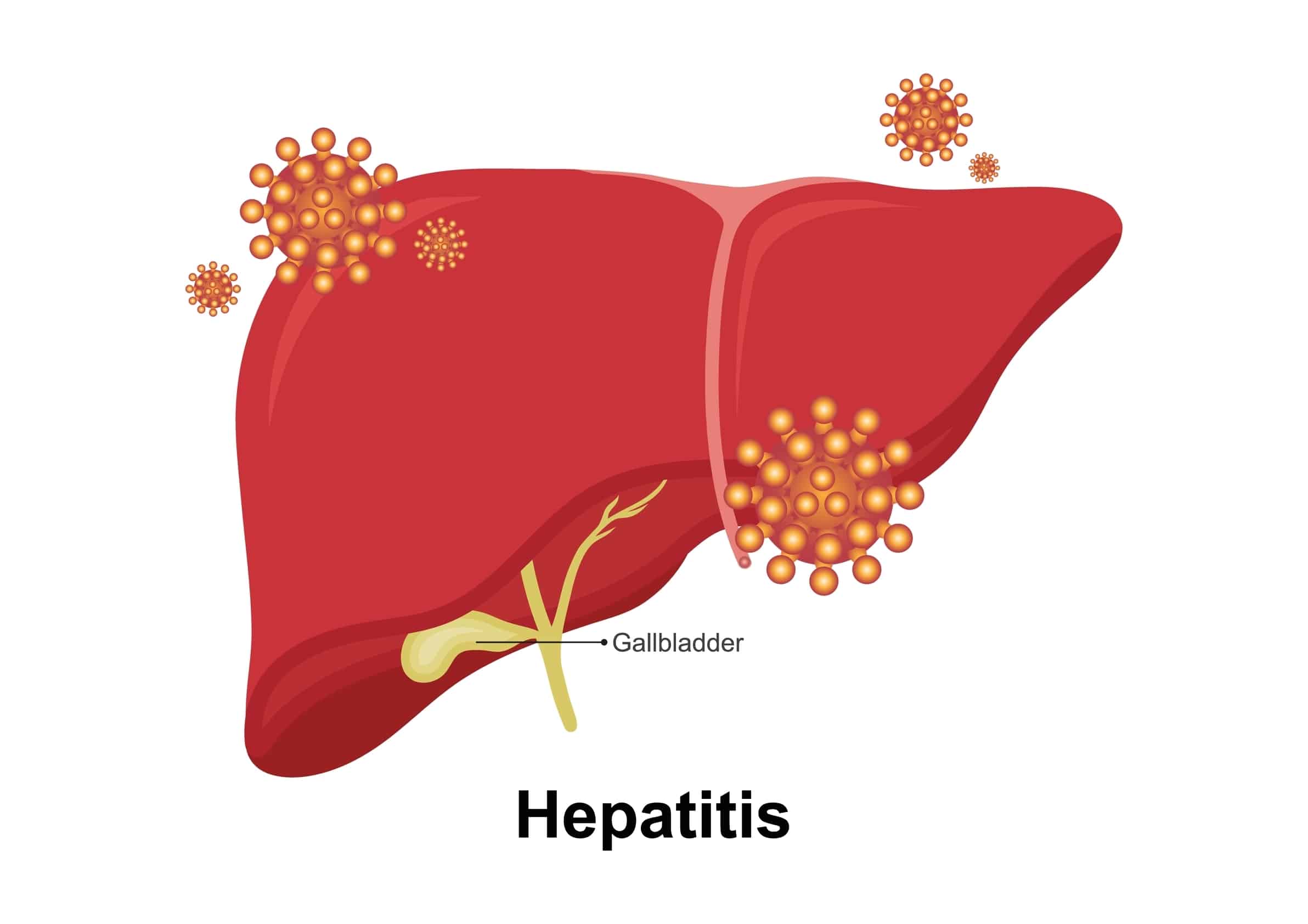 autoimmune hepatitis