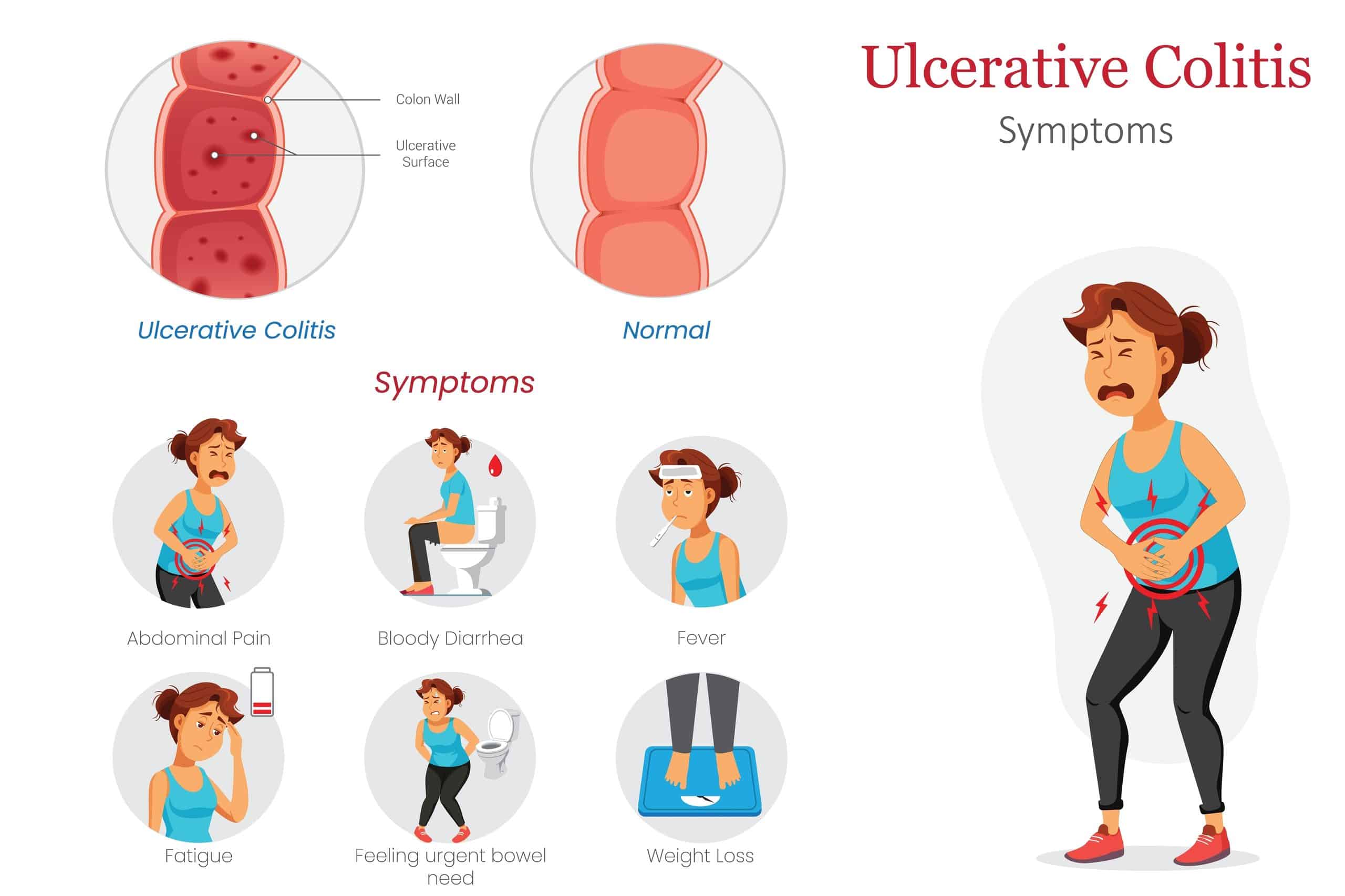 symptoms of ulcerative colitis (UC)