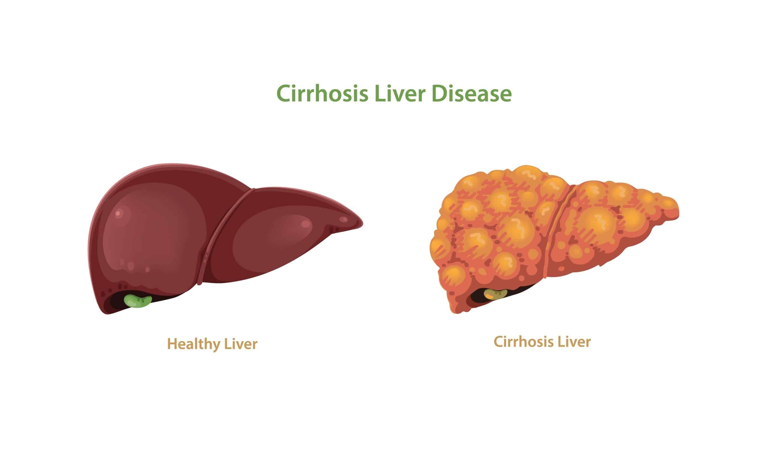 cirrhosis liver