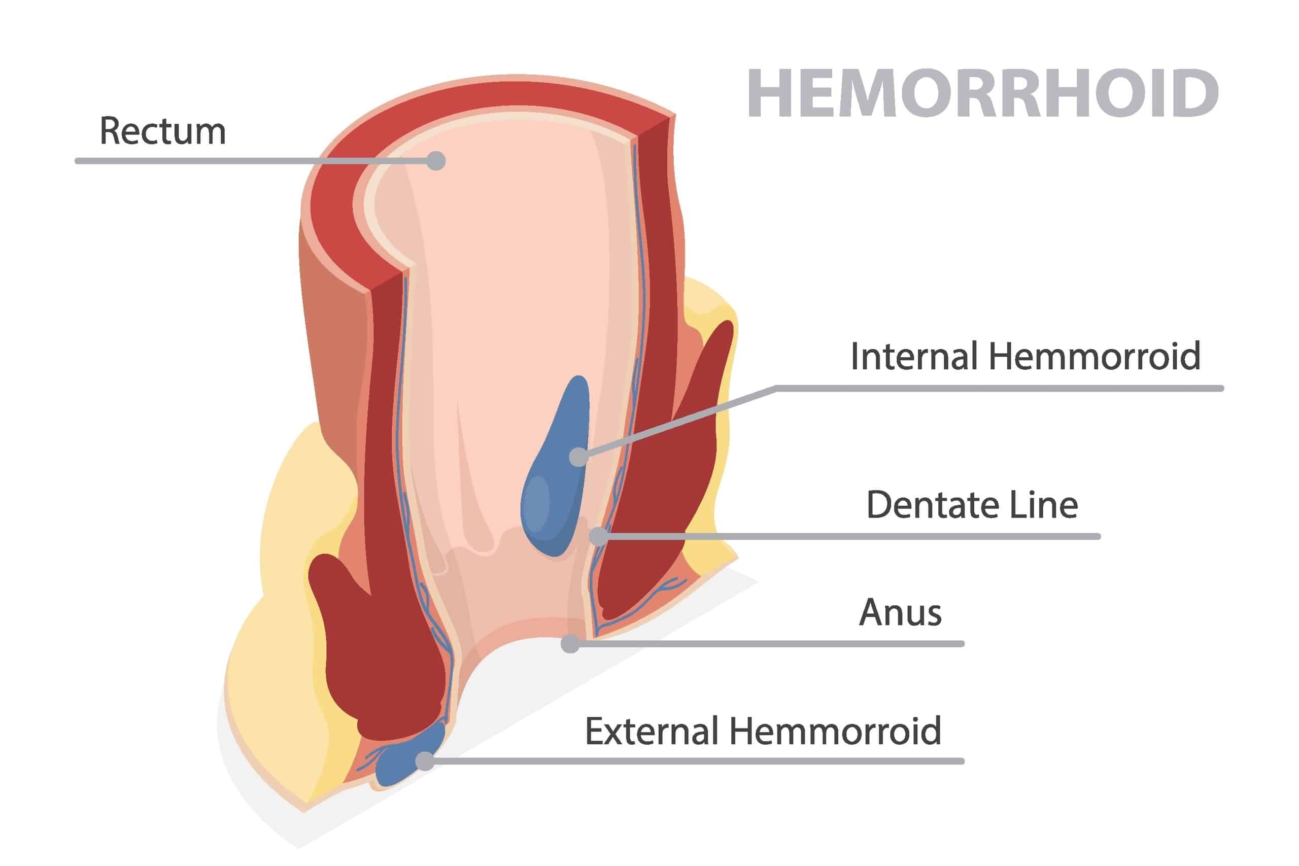 formation of hemorrhoids (piles)