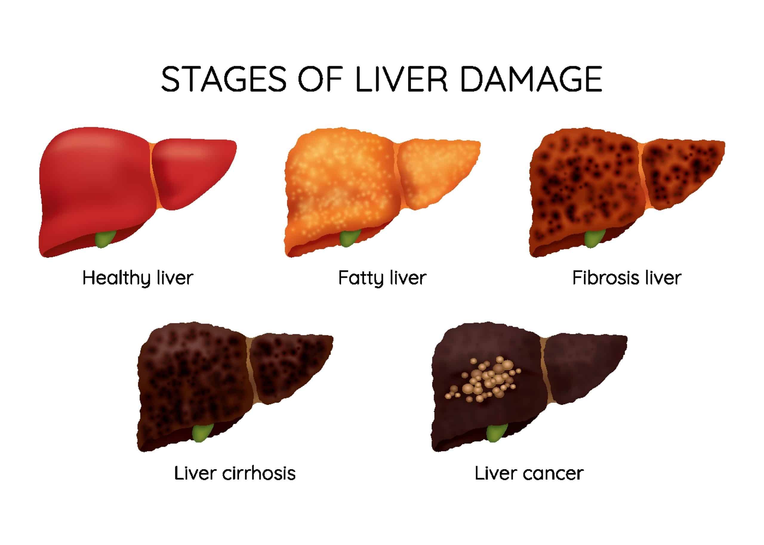 liver damage stages