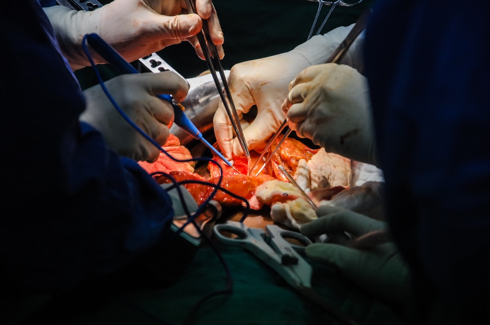 Liver Transplantation