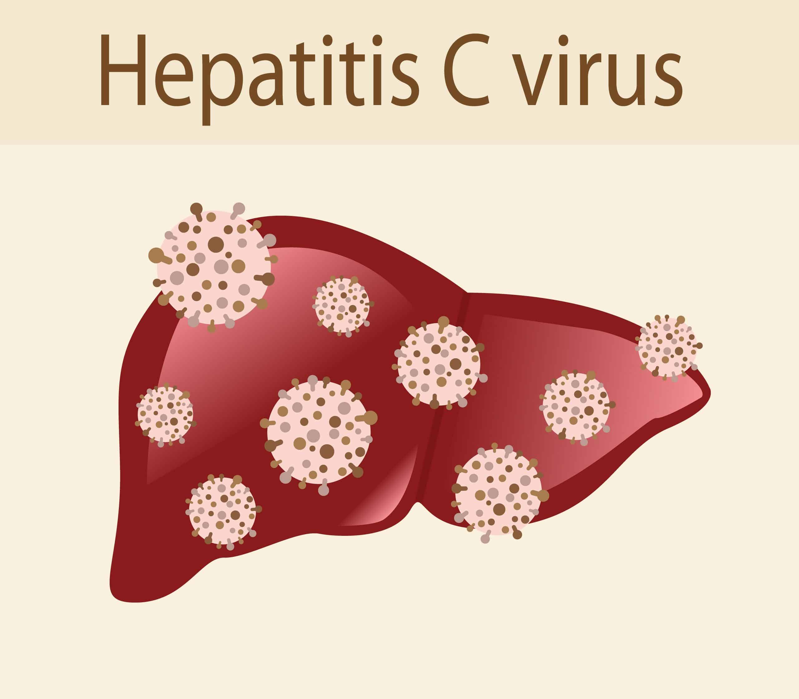 hepatitis c in a human stomach